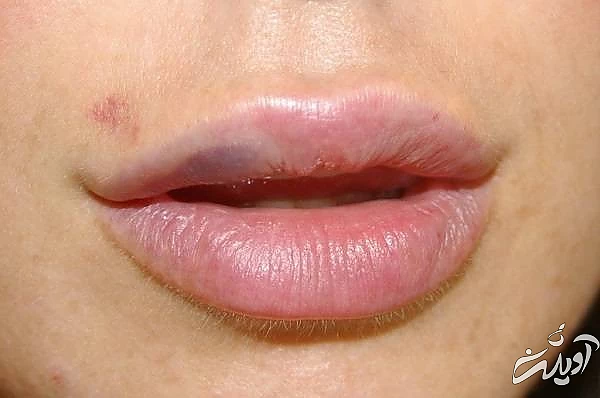 کبودی لب از علائم سکته قلبی است کبودی لب